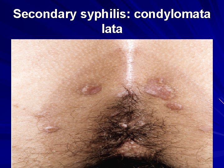 Secondary syphilis: condylomata lata 