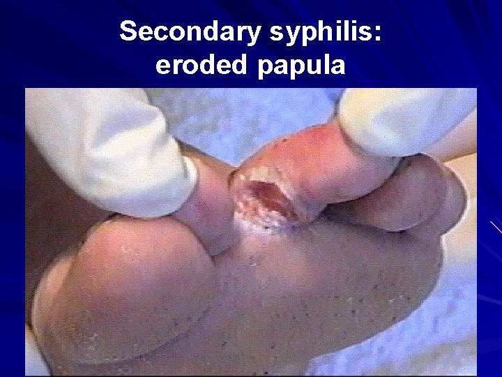 Secondary syphilis: eroded papula 