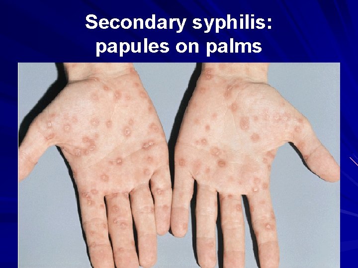 Secondary syphilis: papules on palms 