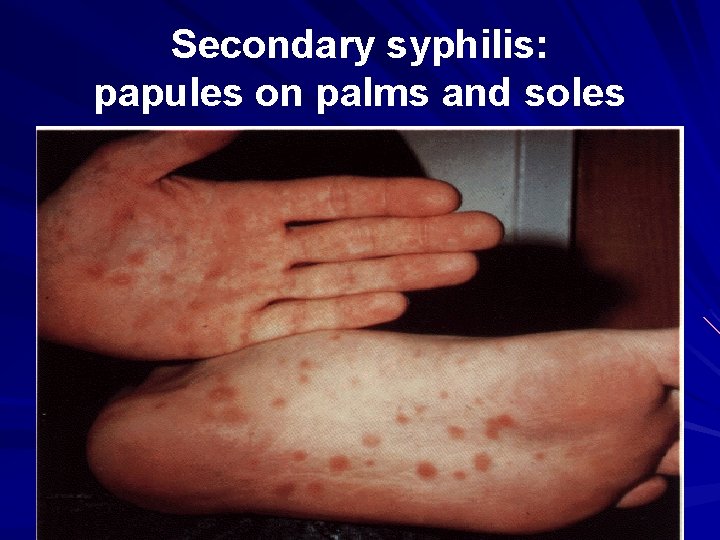 Secondary syphilis: papules on palms and soles 