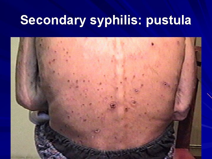 Secondary syphilis: pustula 