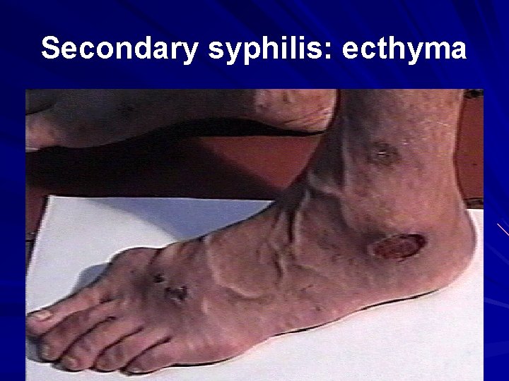 Secondary syphilis: ecthyma 