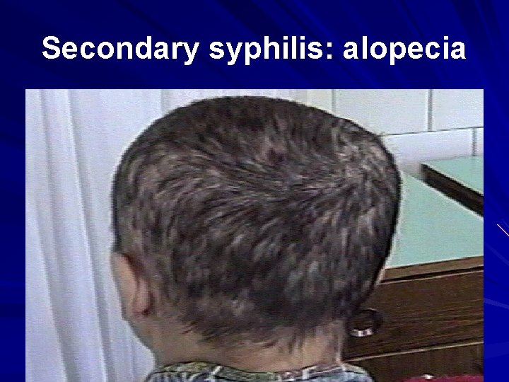 Secondary syphilis: alopecia 