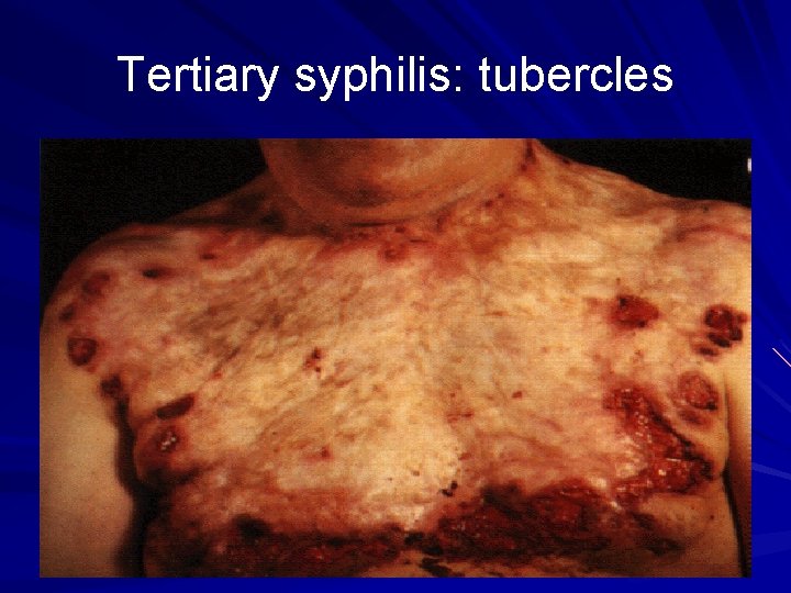 Tertiary syphilis: tubercles 