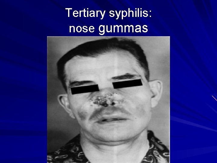 Tertiary syphilis: nose gummas 