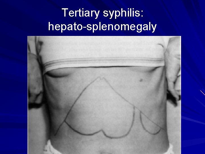 Tertiary syphilis: hepato-splenomegaly 