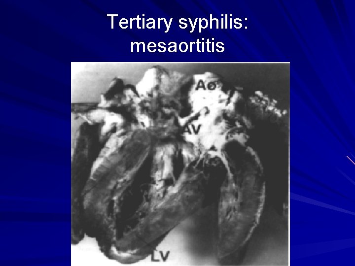 Tertiary syphilis: mesaortitis 
