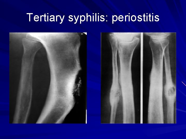Tertiary syphilis: periostitis 