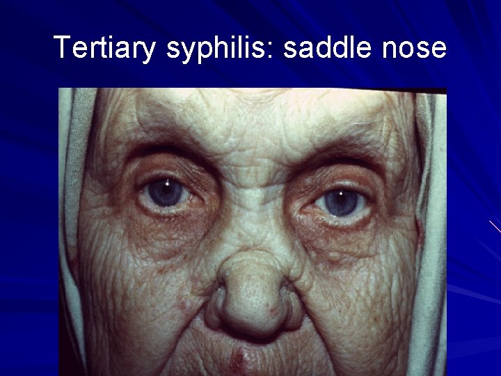 Tertiary syphilis: saddle nose 