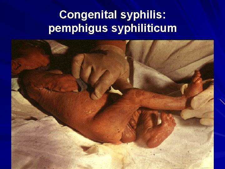 Congenital syphilis: pemphigus syphiliticum 