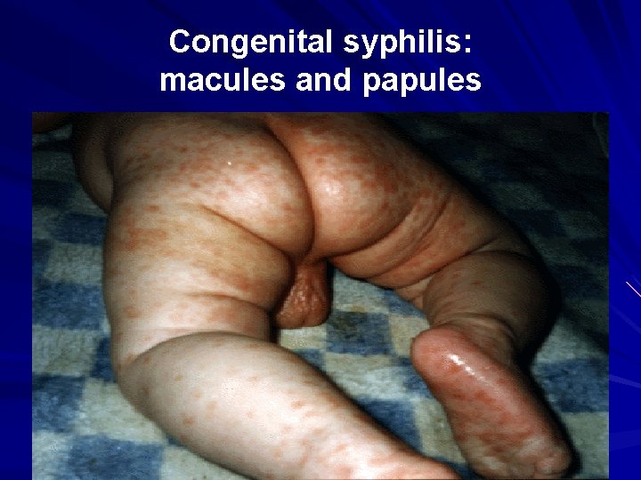 Congenital syphilis: macules and papules 