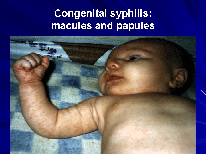 Congenital syphilis: macules and papules 