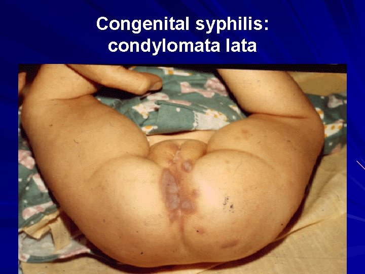 Congenital syphilis: condylomata lata 