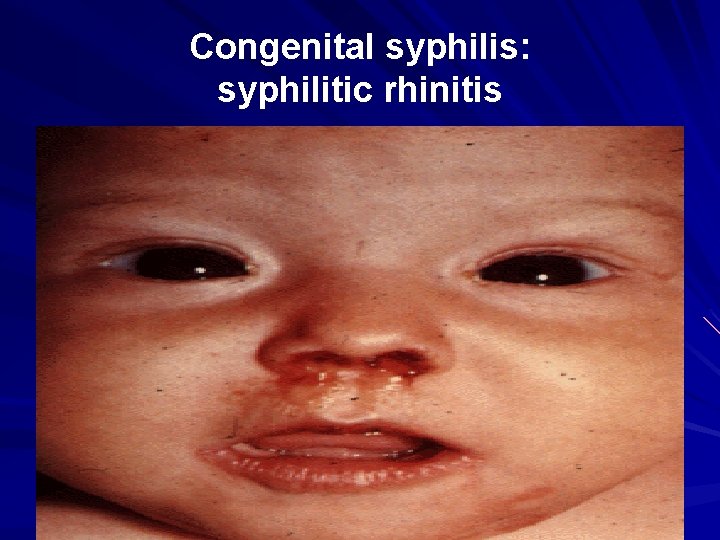 Congenital syphilis: syphilitic rhinitis 