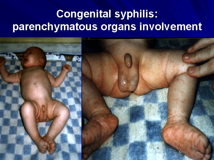Congenital syphilis: parenchymatous organs involvement 