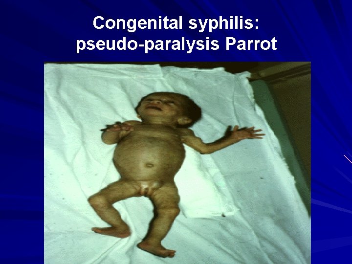 Congenital syphilis: pseudo-paralysis Parrot 