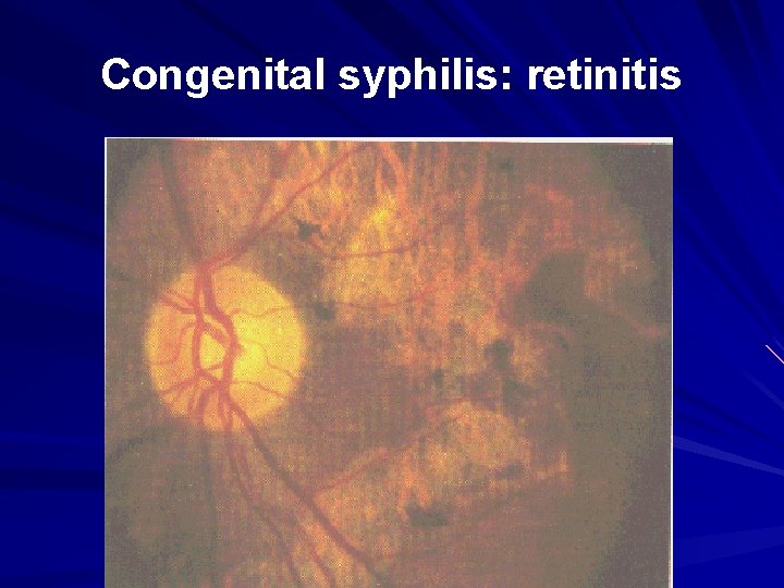 Congenital syphilis: retinitis 