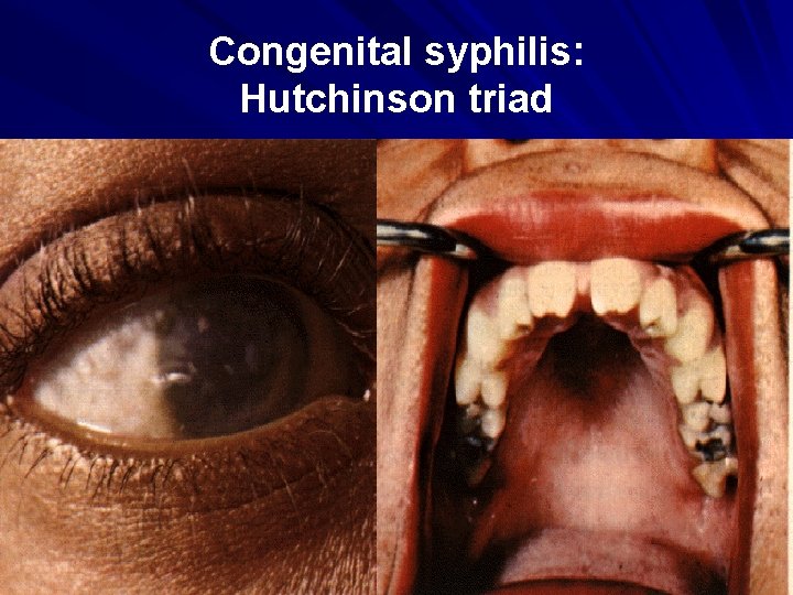 Congenital syphilis: Hutchinson triad 