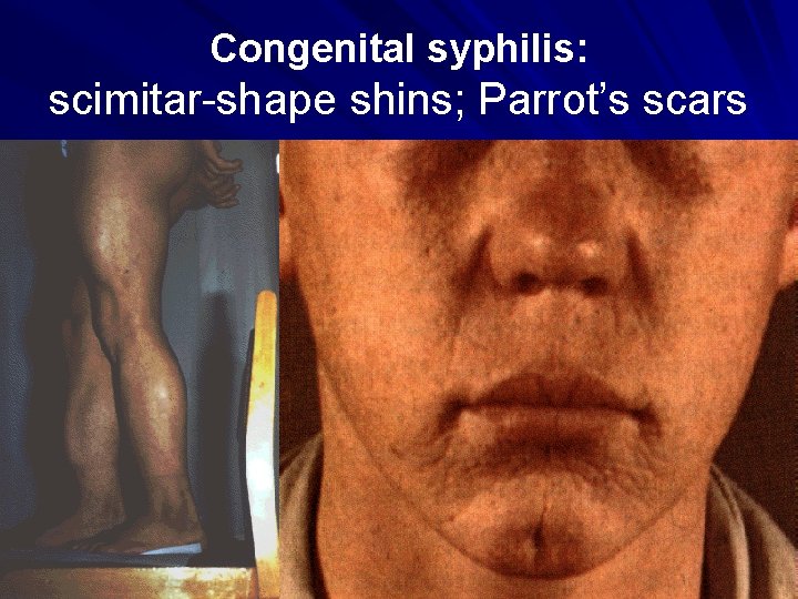 Congenital syphilis: scimitar-shape shins; Parrot’s scars 