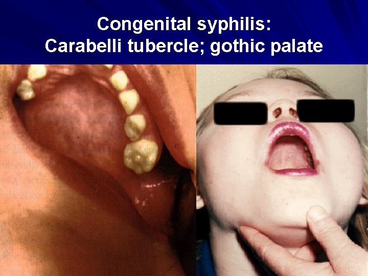 Congenital syphilis: Carabelli tubercle; gothic palate 
