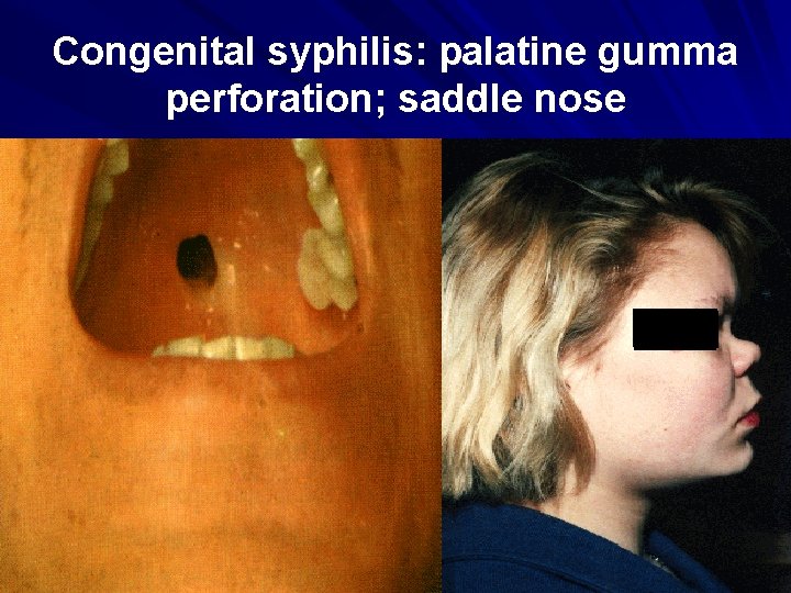 Congenital syphilis: palatine gumma perforation; saddle nose 