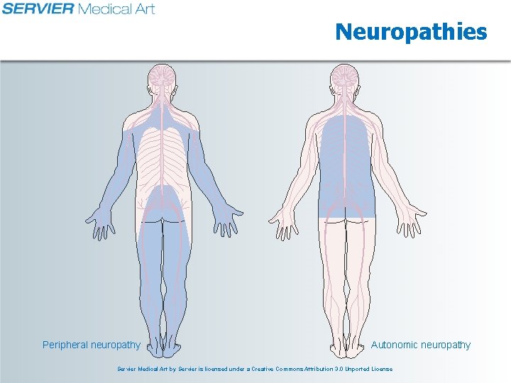 Neuropathies Peripheral neuropathy Autonomic neuropathy Servier Medical Art by Servier is licensed under a