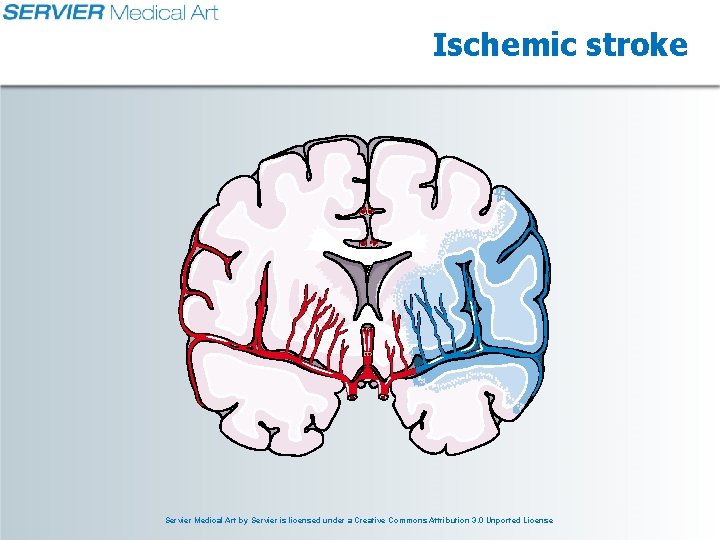 Ischemic stroke Servier Medical Art by Servier is licensed under a Creative Commons Attribution