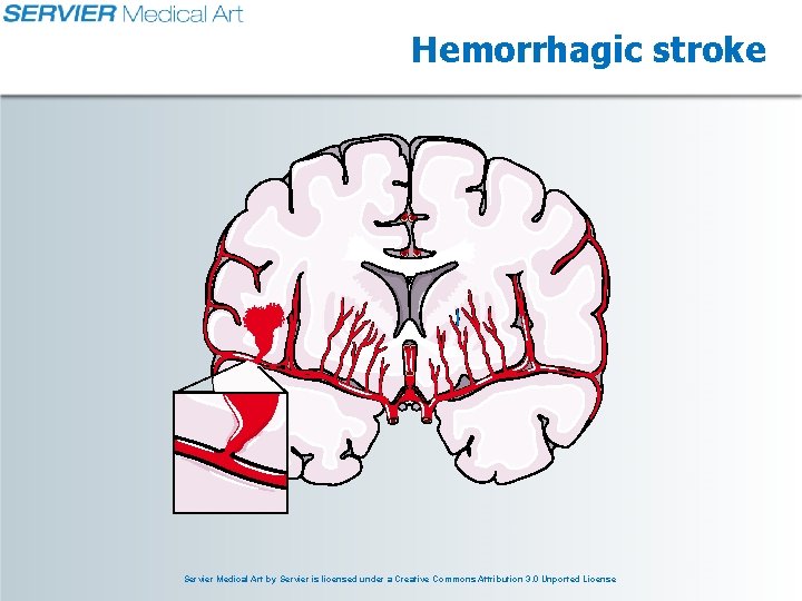 Hemorrhagic stroke Servier Medical Art by Servier is licensed under a Creative Commons Attribution