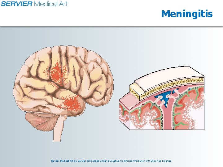 Meningitis Servier Medical Art by Servier is licensed under a Creative Commons Attribution 3.