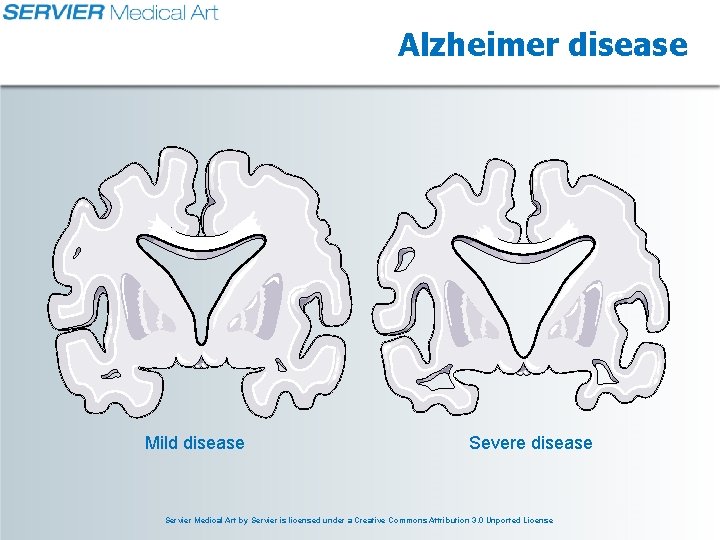 Alzheimer disease Mild disease Severe disease Servier Medical Art by Servier is licensed under