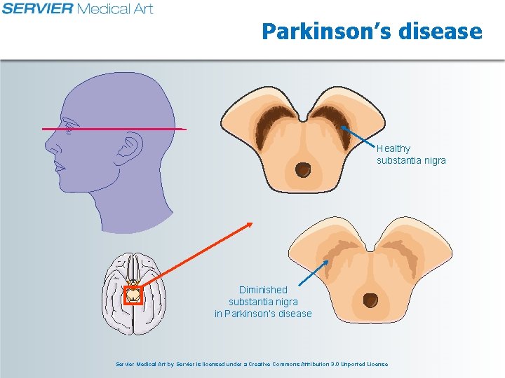 Parkinson’s disease Healthy substantia nigra Diminished substantia nigra in Parkinson’s disease Servier Medical Art