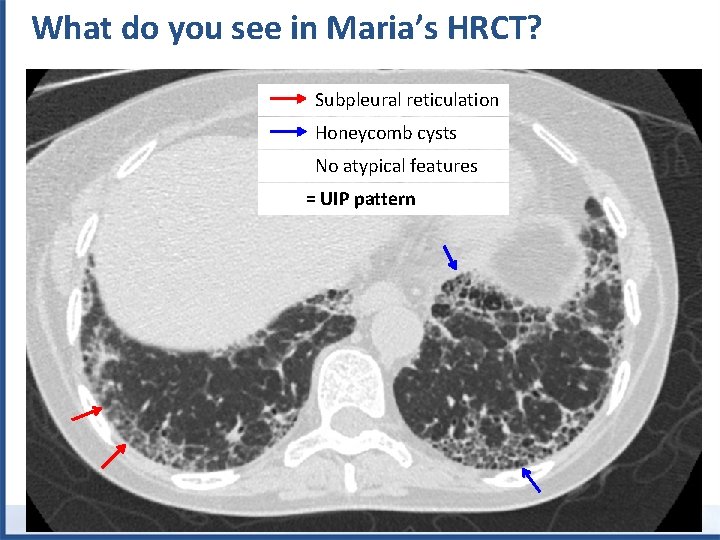 What do you see in Maria’s HRCT? Subpleural reticulation Honeycomb cysts No atypical features