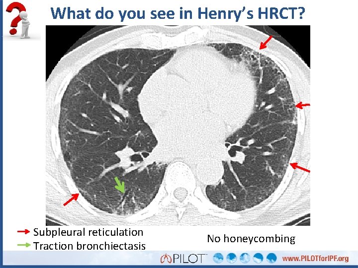 What do you see in Henry’s HRCT? Subpleural reticulation Traction bronchiectasis No honeycombing 