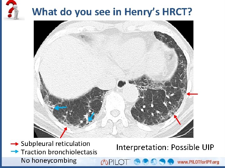 What do you see in Henry’s HRCT? Subpleural reticulation Traction bronchiolectasis No honeycombing Interpretation: