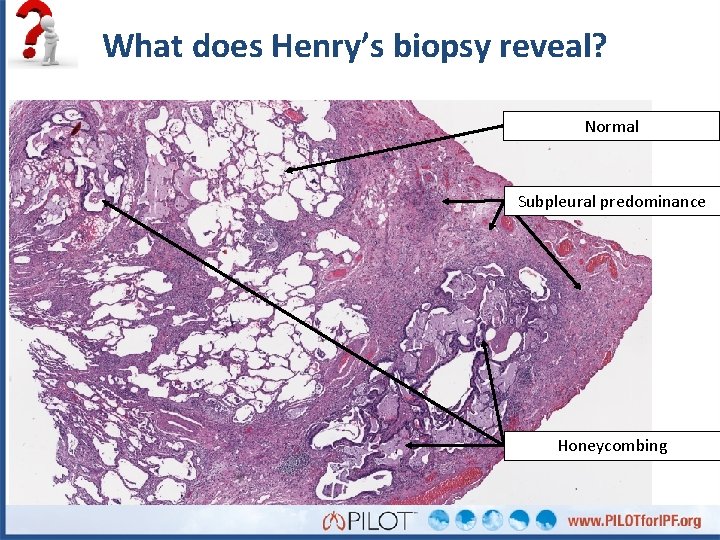 What does Henry’s biopsy reveal? Normal Subpleural predominance Honeycombing 