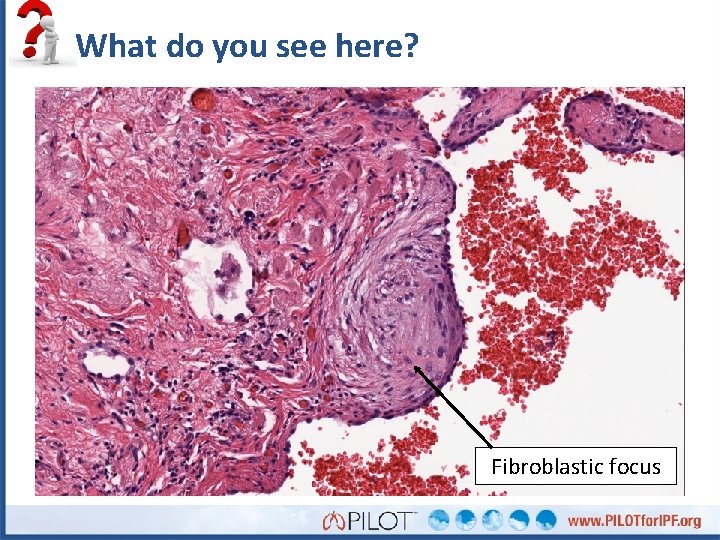What do you see here? Fibroblastic focus 