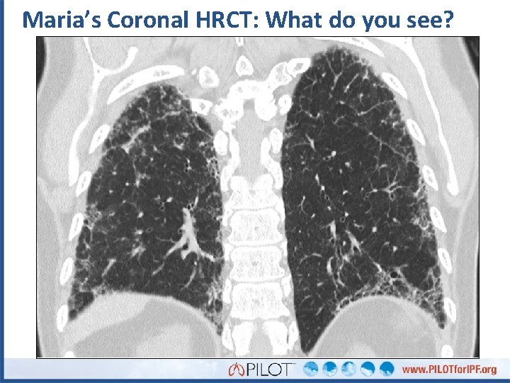 Maria’s Coronal HRCT: What do you see? 