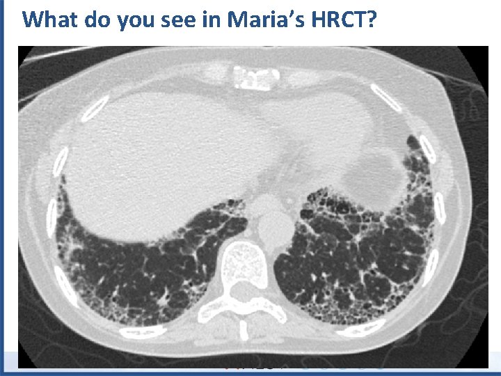 What do you see in Maria’s HRCT? 