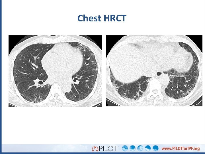 Chest HRCT 