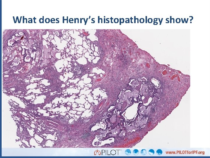 What does Henry’s histopathology show? 