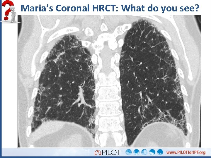 Maria’s Coronal HRCT: What do you see? 