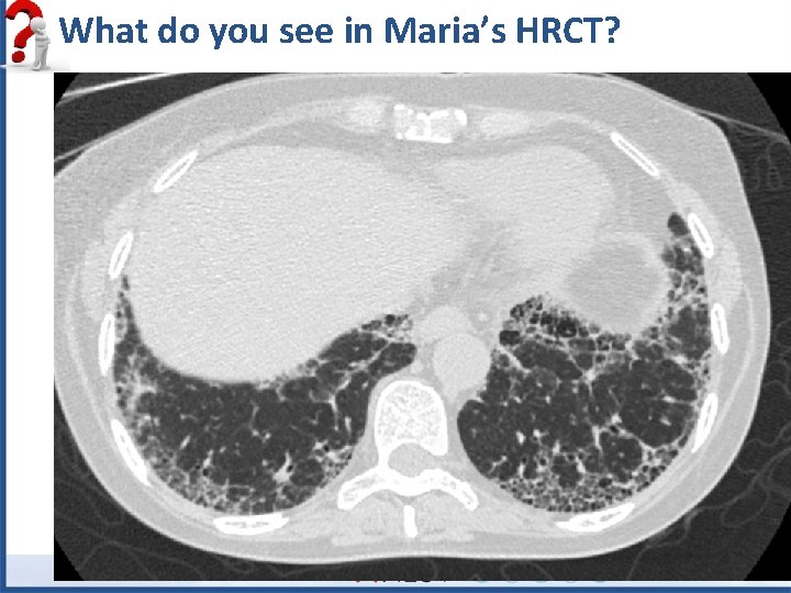 What do you see in Maria’s HRCT? 