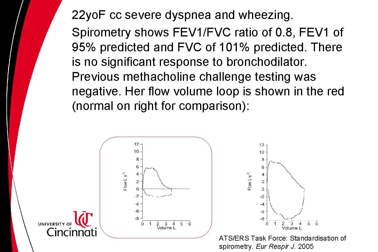 22 yo. F cc severe dyspnea and wheezing. Spirometry shows FEV 1/FVC ratio of 22 yo. F cc severe dyspnea and wheezing. Spirometry shows FEV 1/FVC ratio of