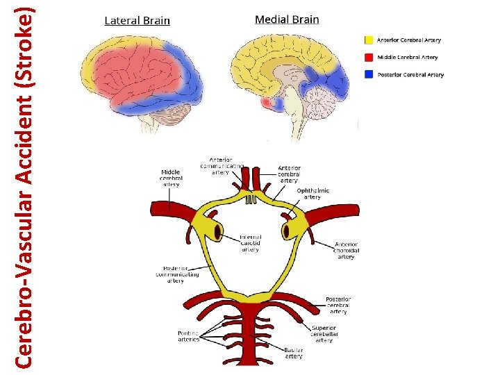 Cerebro-Vascular Accident (Stroke) 