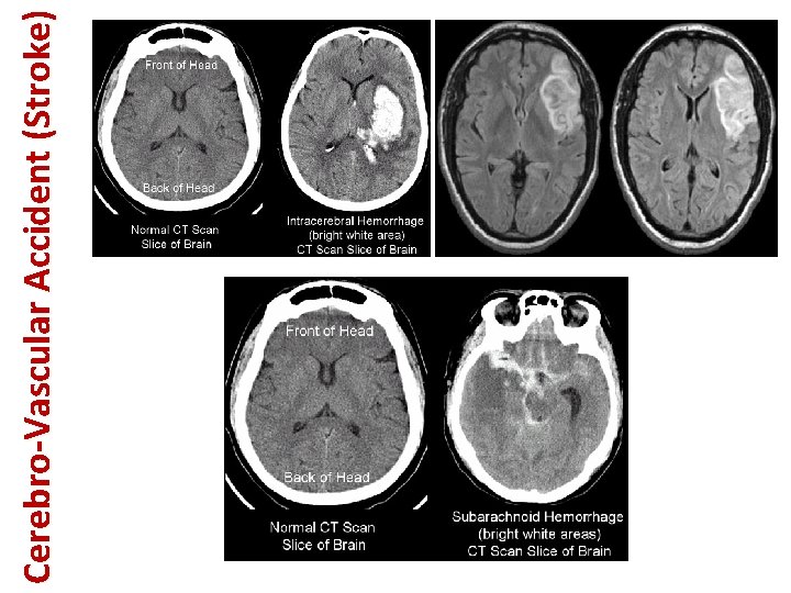 Cerebro-Vascular Accident (Stroke) 