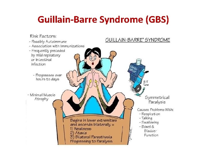 Guillain-Barre Syndrome (GBS) 