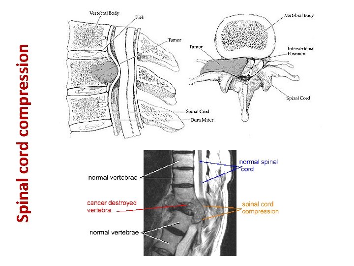 Spinal cord compression 