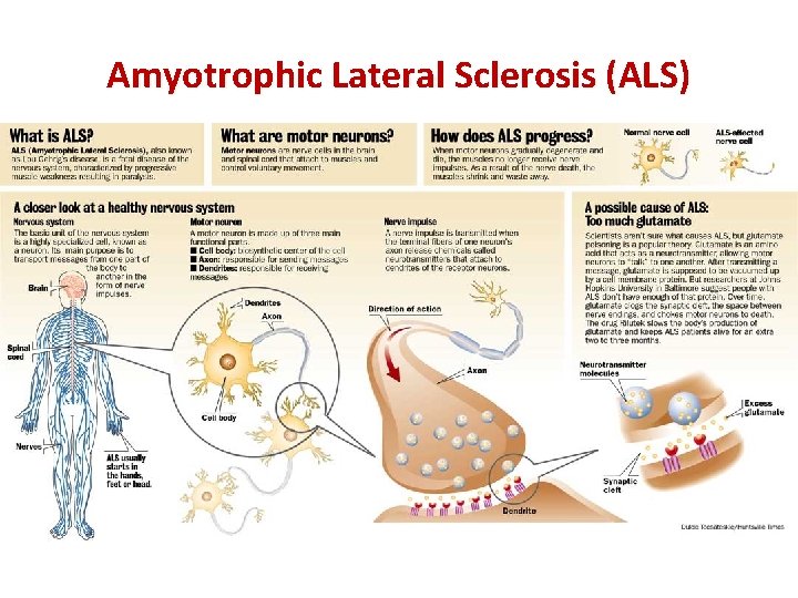Amyotrophic Lateral Sclerosis (ALS) 