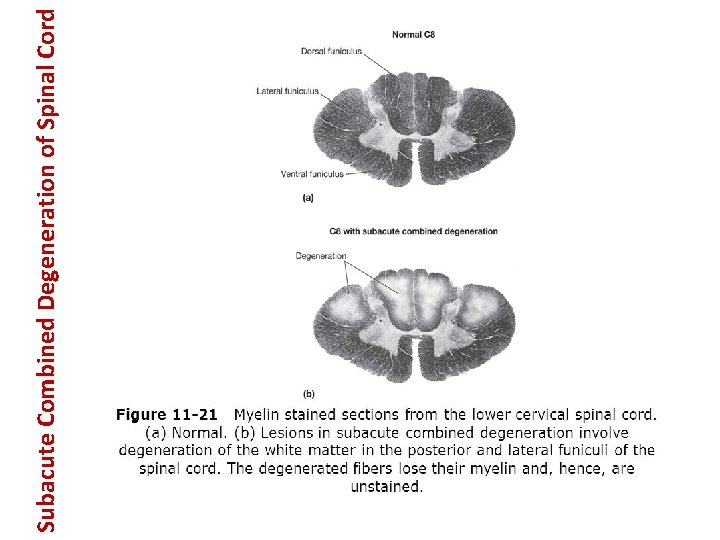 Subacute Combined Degeneration of Spinal Cord 