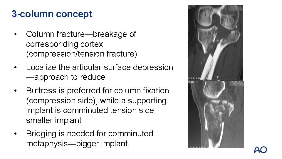3 -column concept • Column fracture—breakage of corresponding cortex (compression/tension fracture) • Localize the
